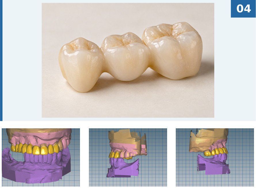 Zahnbrücke
