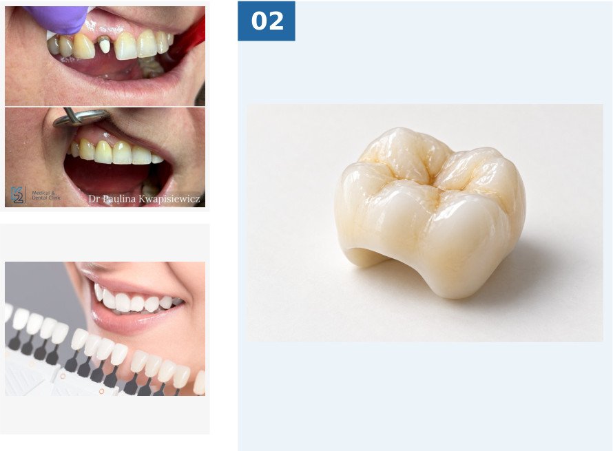 Cercon zirconia crown