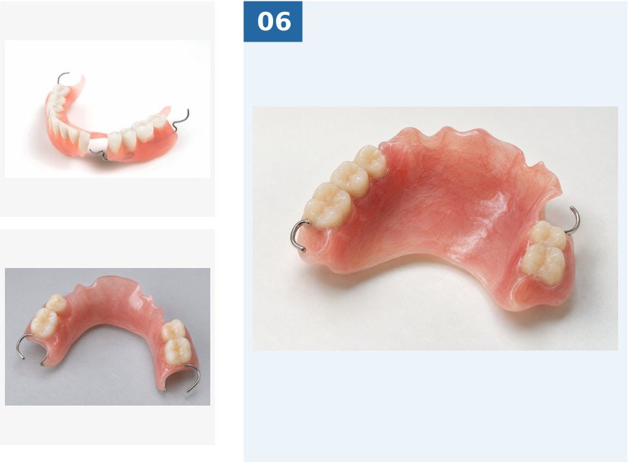 Partial acrylic denture